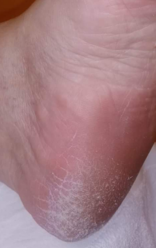 Before photo showing dry rough cracked heels prior to DermaPure foot care