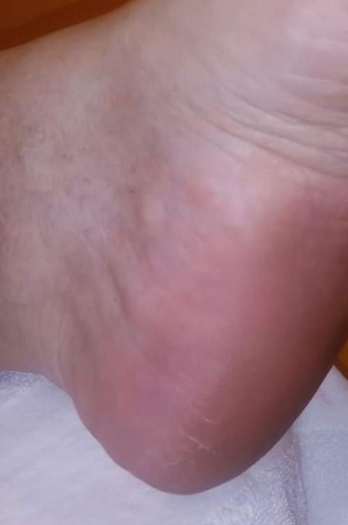 After photo showing smoother-looking heels following DermaPure foot care