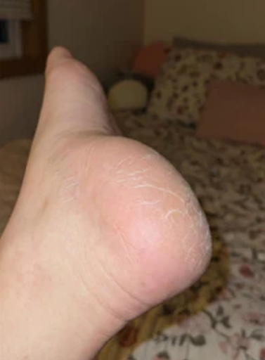 Before photo showing dry rough cracked heels prior to DermaPure foot care