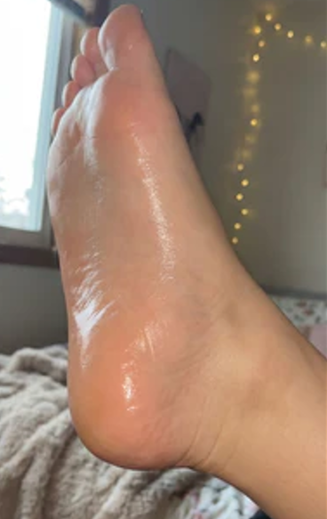 After photo showing smoother-looking heels following DermaPure foot care