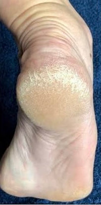 Before photo showing dry rough cracked heels prior to DermaPure foot care