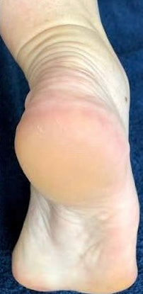 After photo showing smoother-looking heels following DermaPure foot care