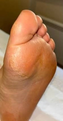 Before photo showing dry rough cracked heels prior to DermaPure foot care