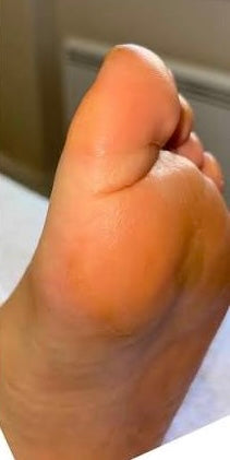 After photo showing smoother-looking heels following DermaPure foot care